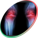 OSTEOARTHRITIS