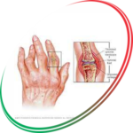 RHEUMATOID ARTHRITIS