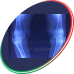 Total Knee Replacement